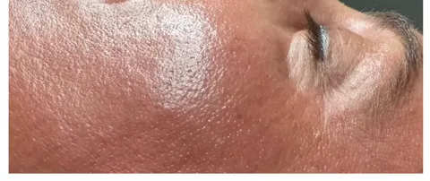 Huid met glow na de behandeling