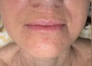 Lippen en kin na de behandeling