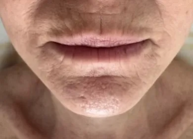 Lippen en kin voor de behandeling